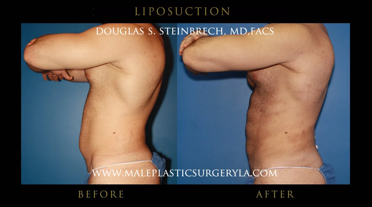 Liposuction - Before & After Photos