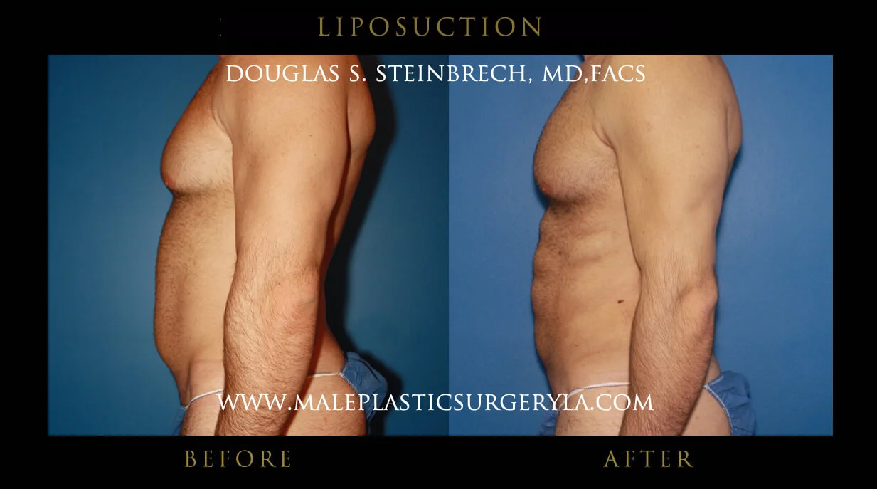 Liposuction - Before & After Photos