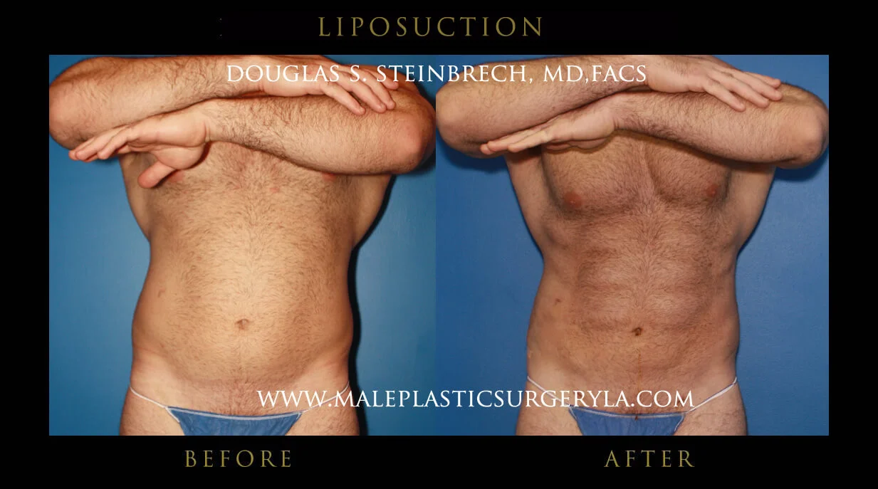 Liposuction - Before & After Photos