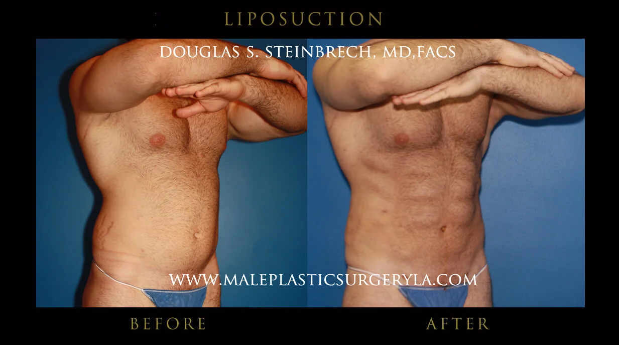 Liposuction - Before & After Photos