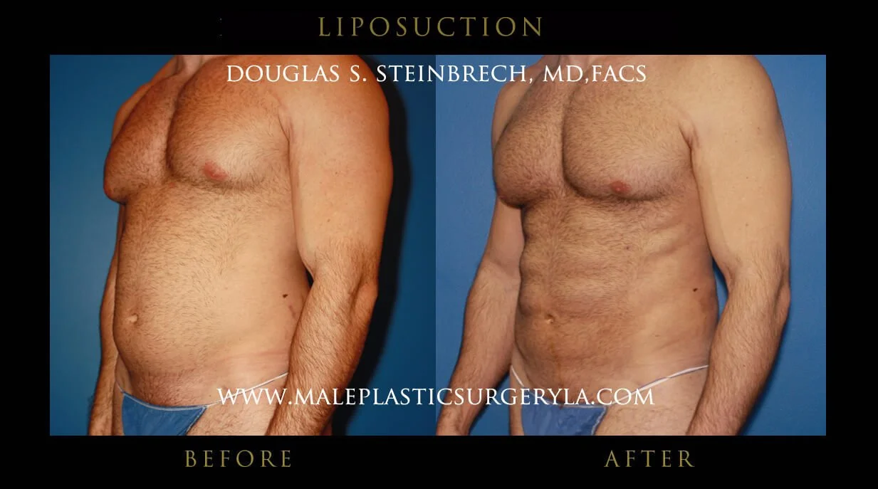 Liposuction - Before & After Photos