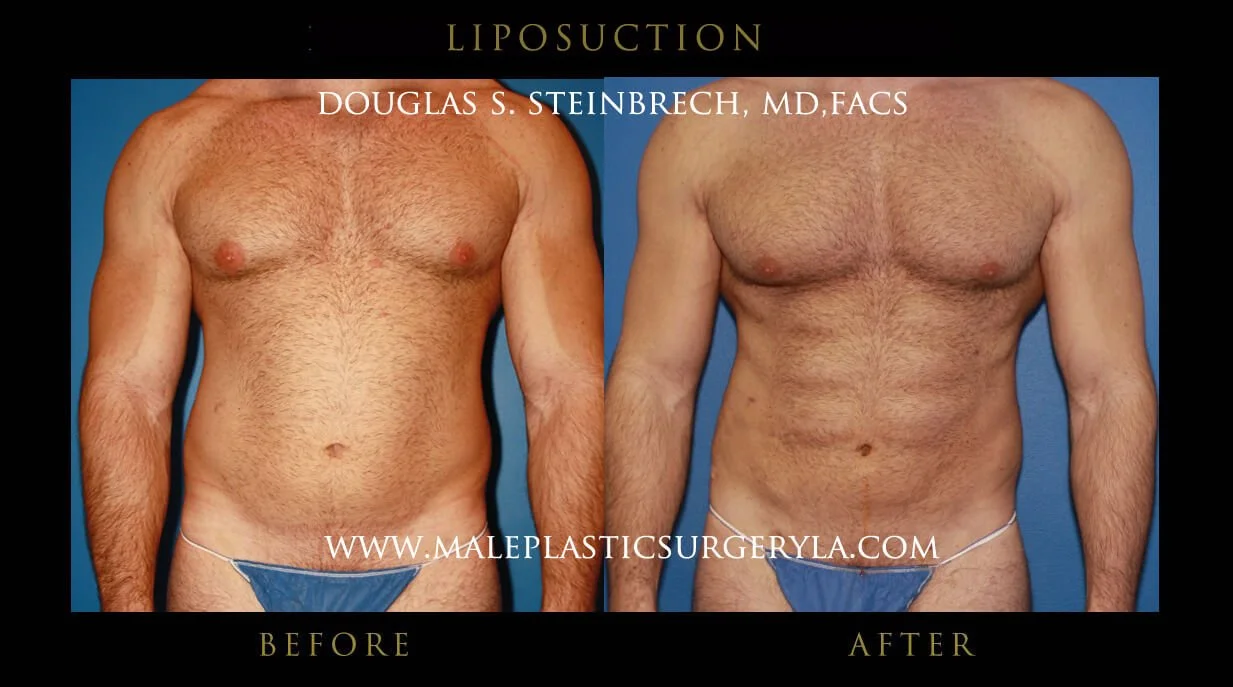 Liposuction - Before & After Photos