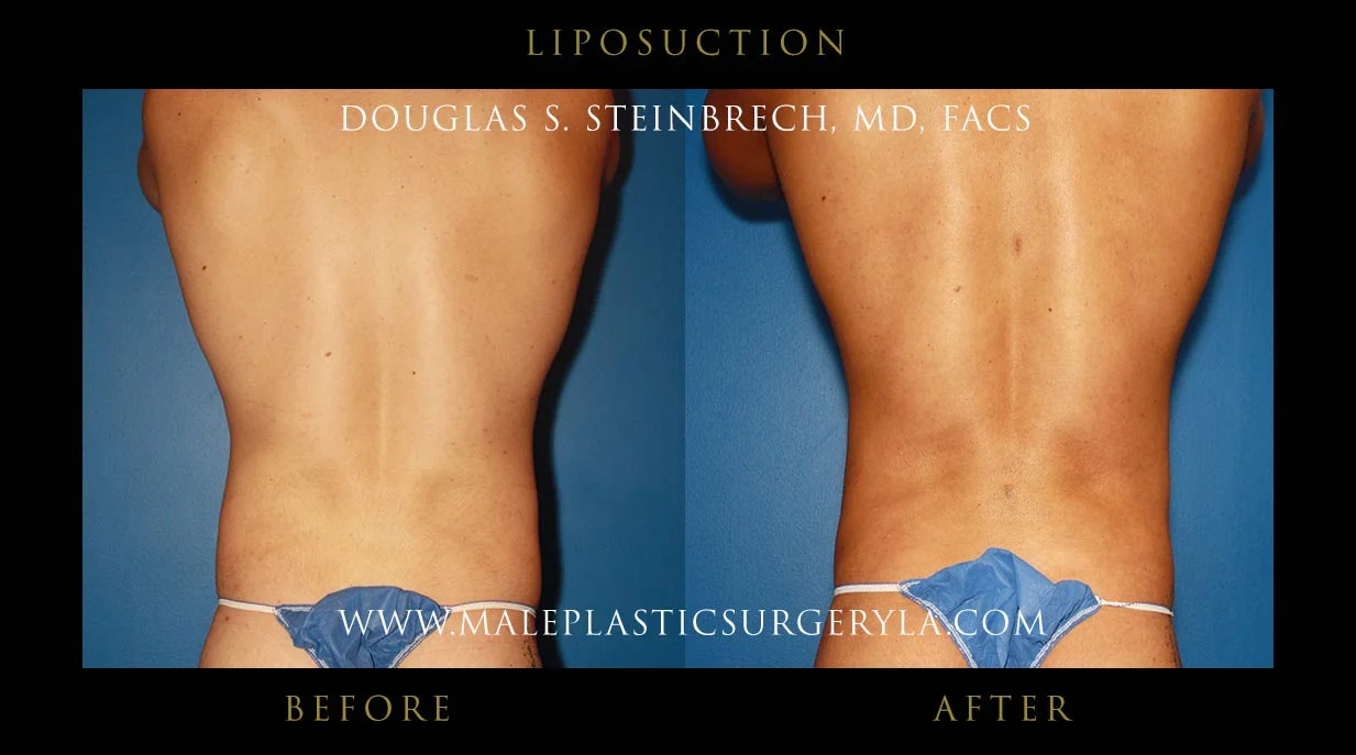 Liposuction - Before & After Photos