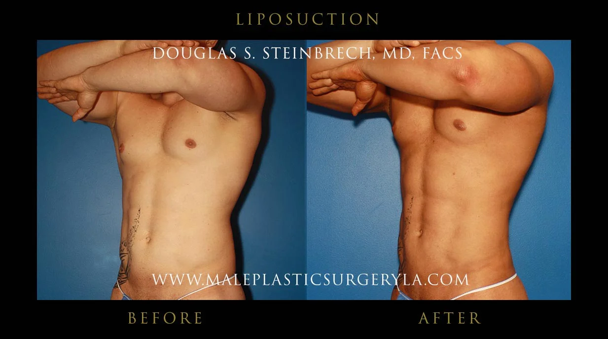 Liposuction - Before & After Photos