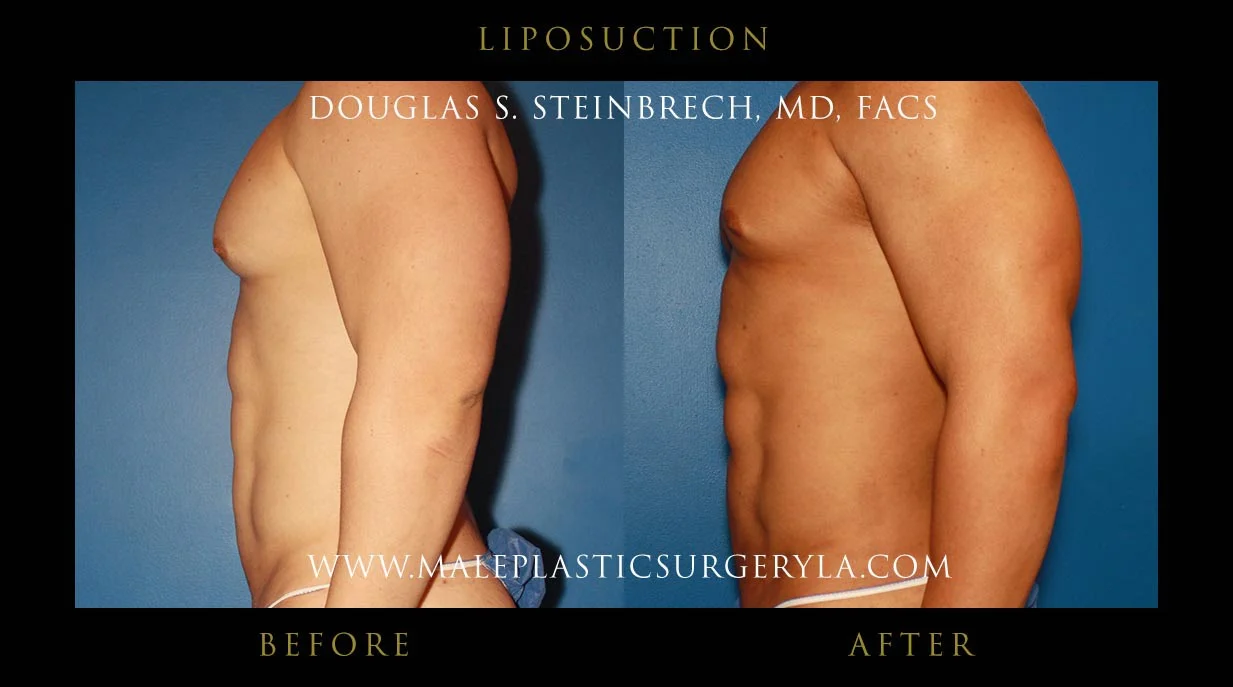 Liposuction - Before & After Photos