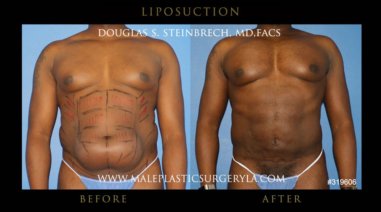 Liposuction - Before & After Photos