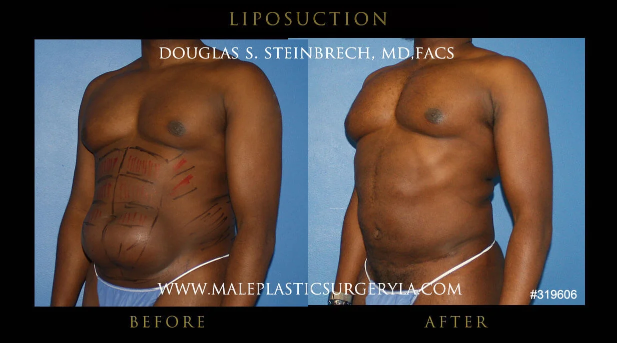 Liposuction - Before & After Photos