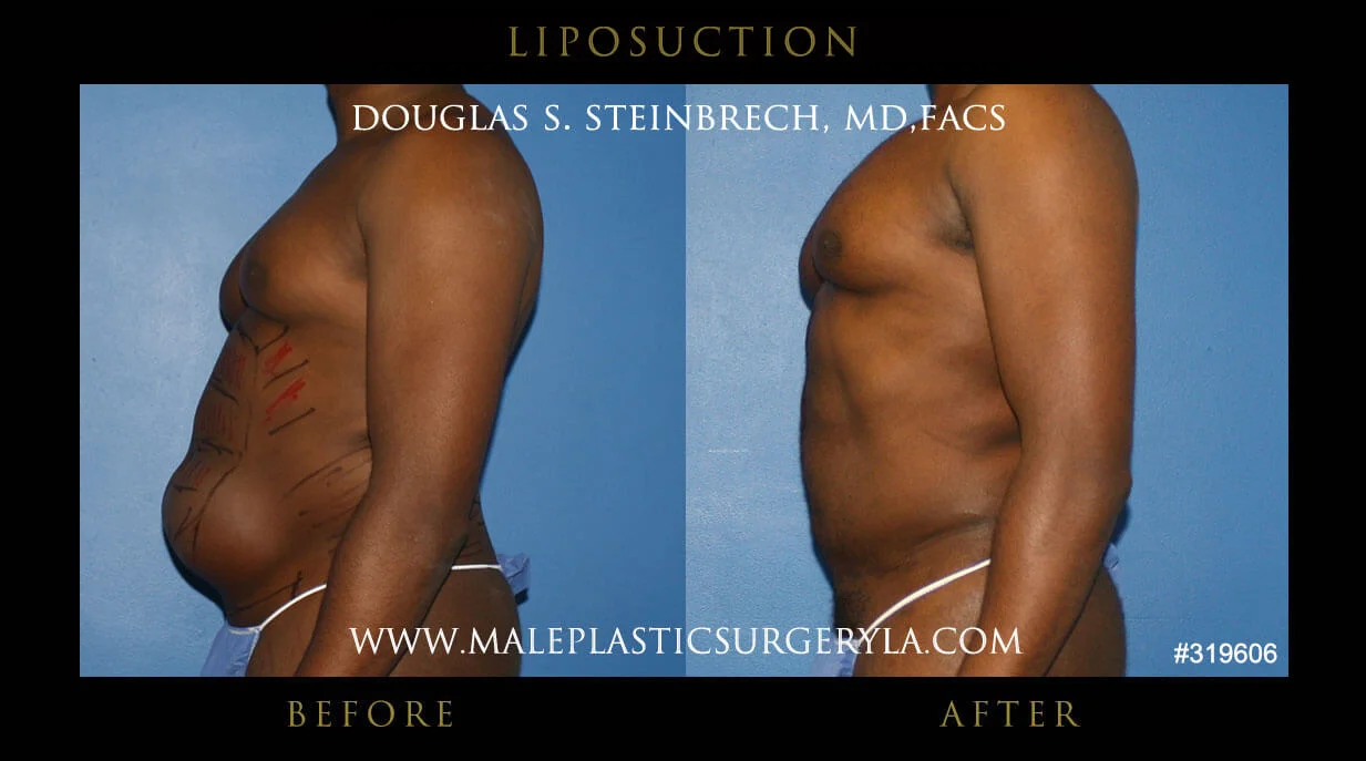 Liposuction - Before & After Photos