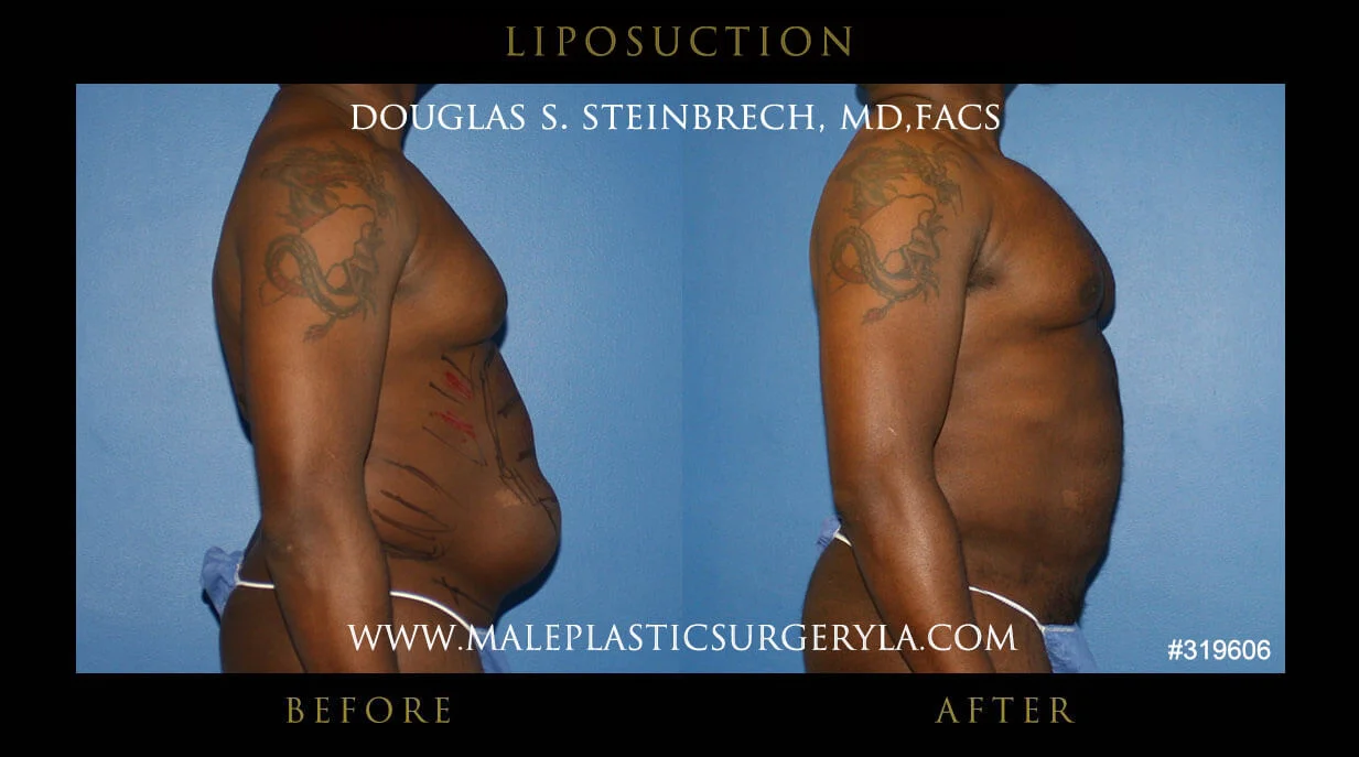 Liposuction - Before & After Photos