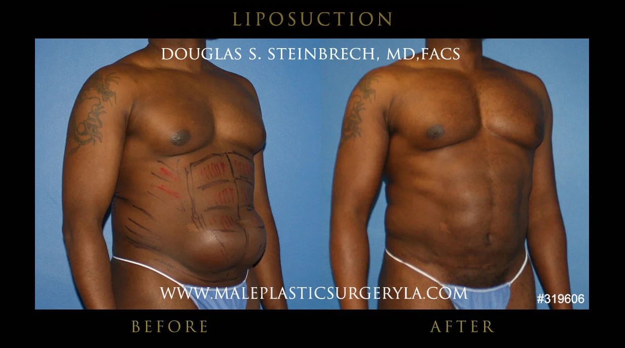 Liposuction - Before & After Photos