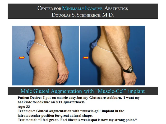 Gluteal Buttock Implants - Before & After Photos