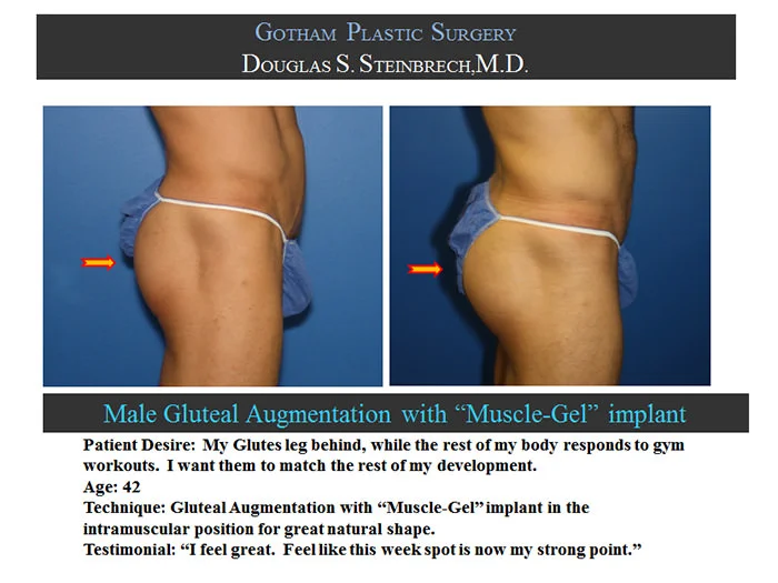 Gluteal Buttock Implants - Before & After Photos