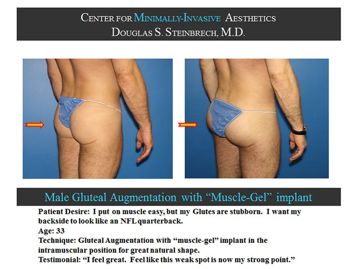 Gluteal Buttock Implants - Before & After Photos