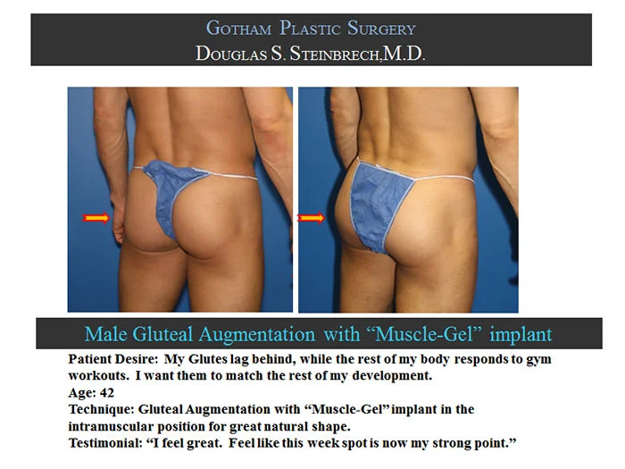 Gluteal Buttock Implants - Before & After Photos