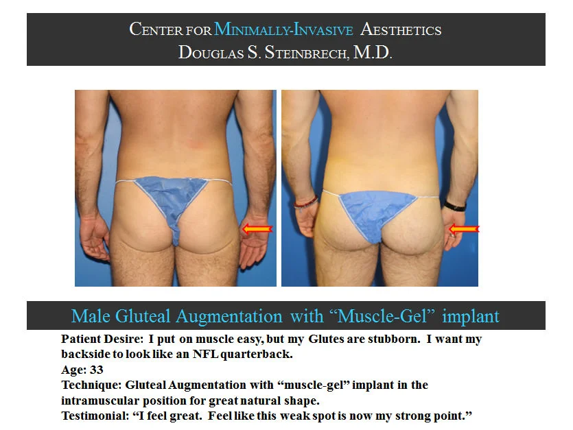 Gluteal Buttock Implants - Before & After Photos