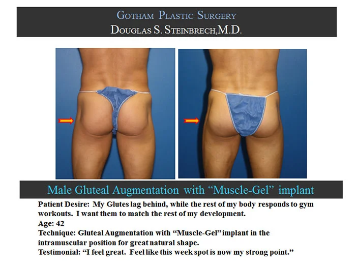 Gluteal Buttock Implants - Before & After Photos