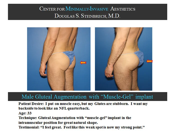 Gluteal Buttock Implants - Before & After Photos