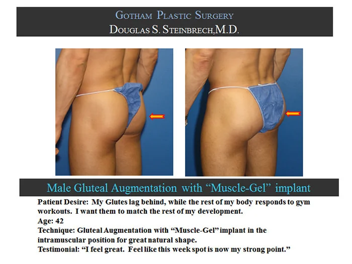 Gluteal Buttock Implants - Before & After Photos