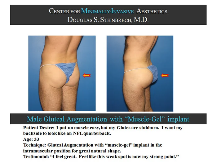 Gluteal Buttock Implants - Before & After Photos