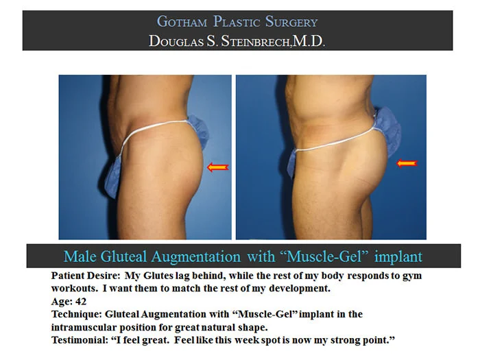 Gluteal Buttock Implants - Before & After Photos