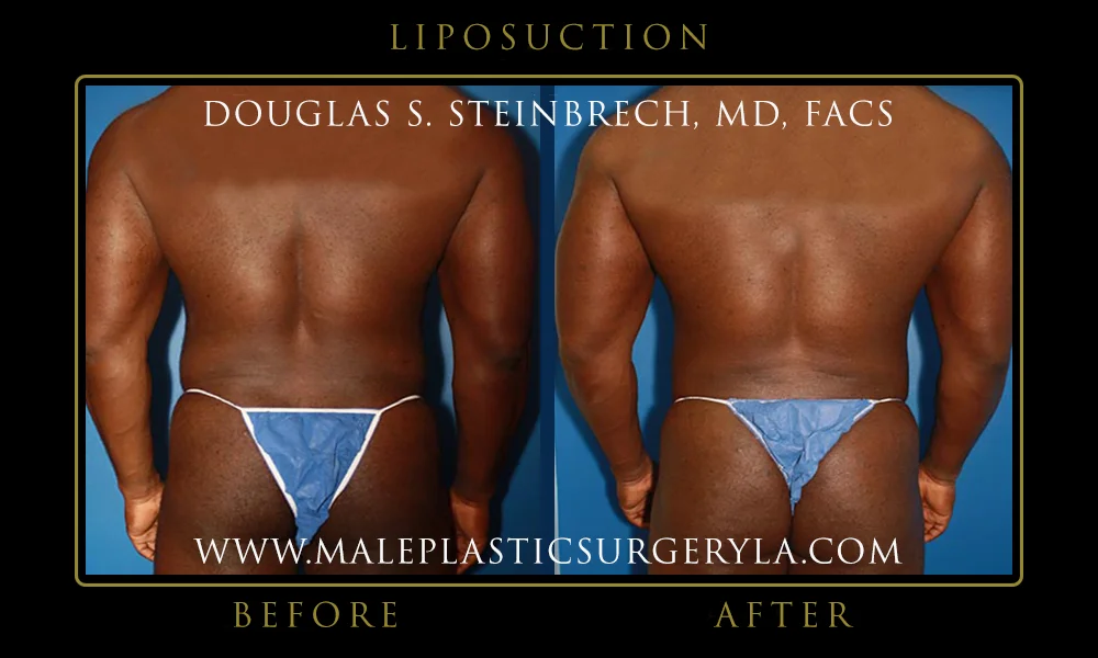 Liposuction - Before & After Photos