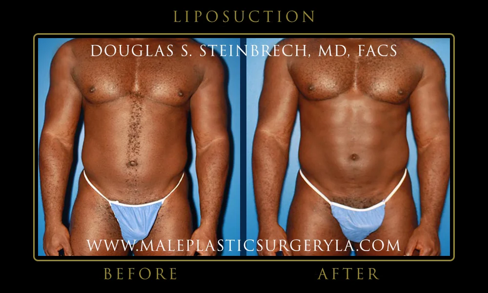 Liposuction - Before & After Photos