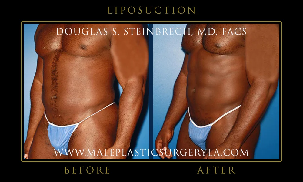 Liposuction - Before & After Photos