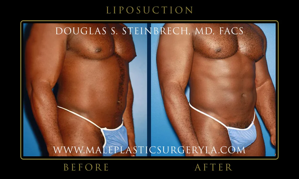 Liposuction - Before & After Photos