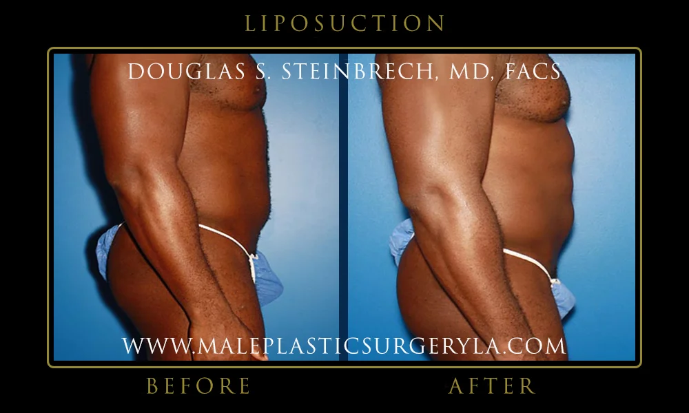 Liposuction - Before & After Photos