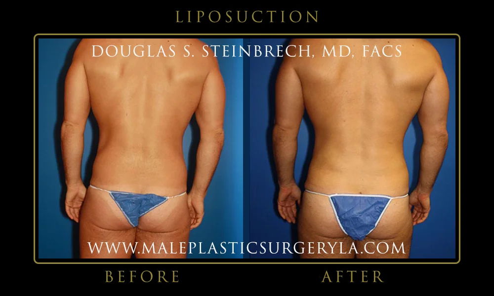 Liposuction - Before & After Photos