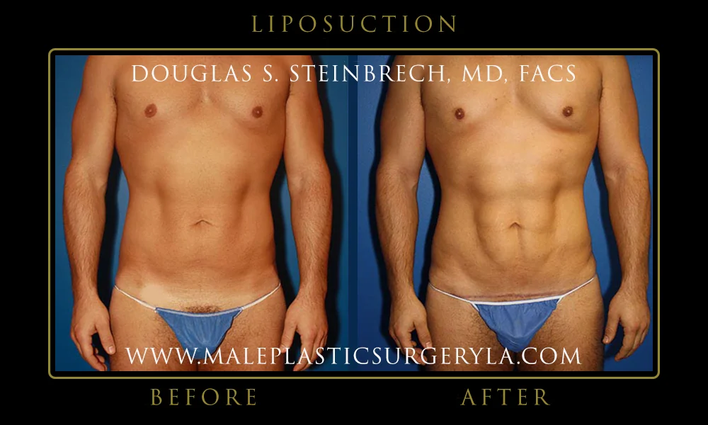 Liposuction - Before & After Photos