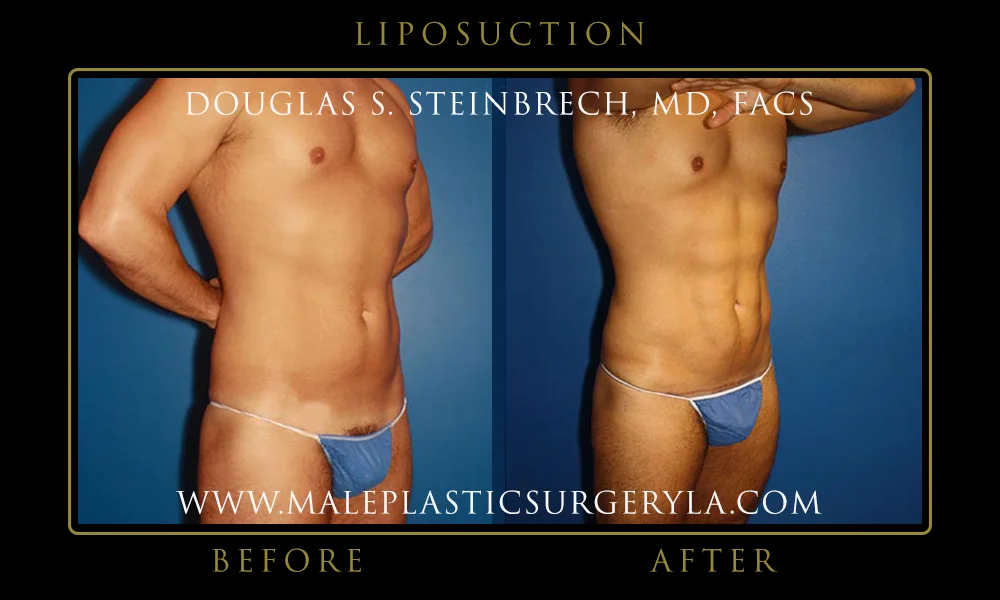 Liposuction - Before & After Photos