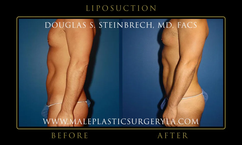 Liposuction - Before & After Photos