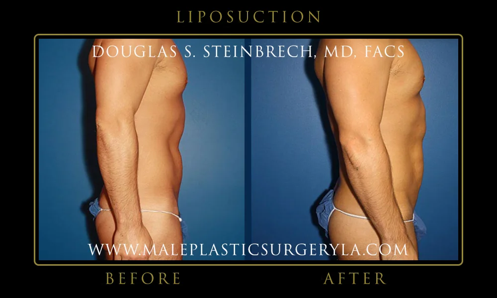 Liposuction - Before & After Photos