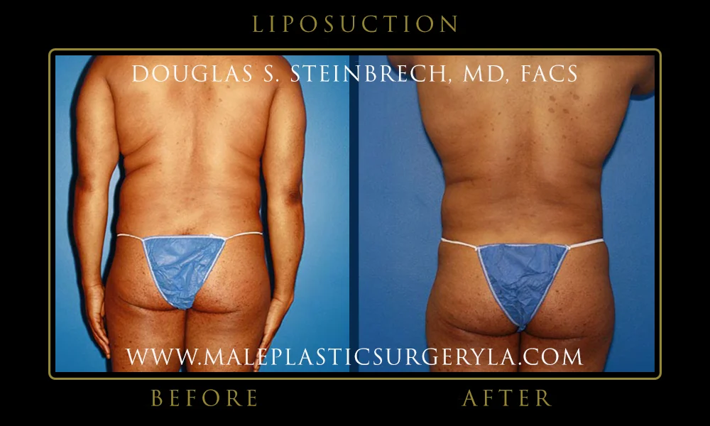 Liposuction - Before & After Photos