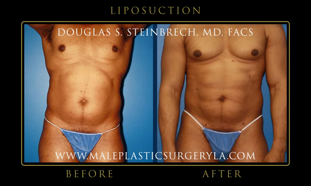 Liposuction - Before & After Photos