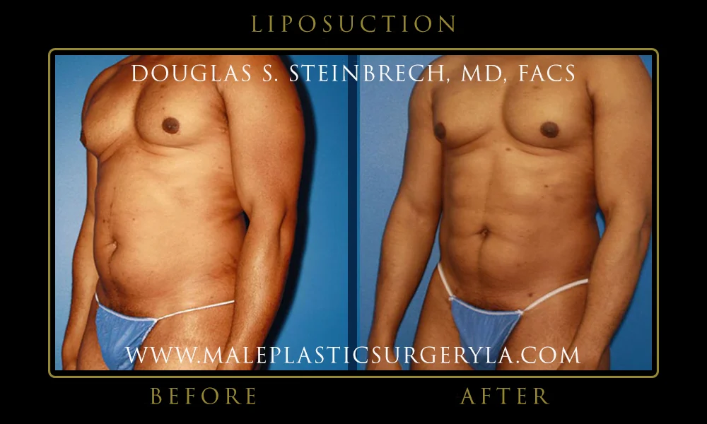 Liposuction - Before & After Photos