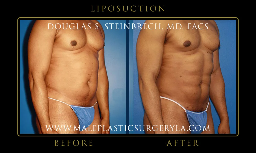 Liposuction - Before & After Photos