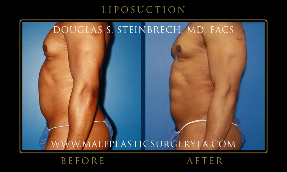 Liposuction - Before & After Photos