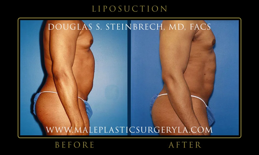 Liposuction - Before & After Photos