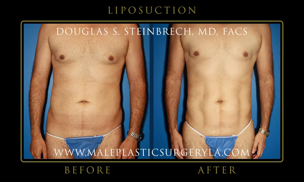 Liposuction - Before & After Photos