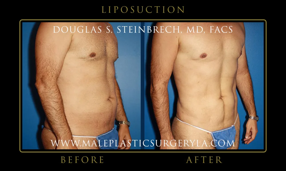 Liposuction - Before & After Photos