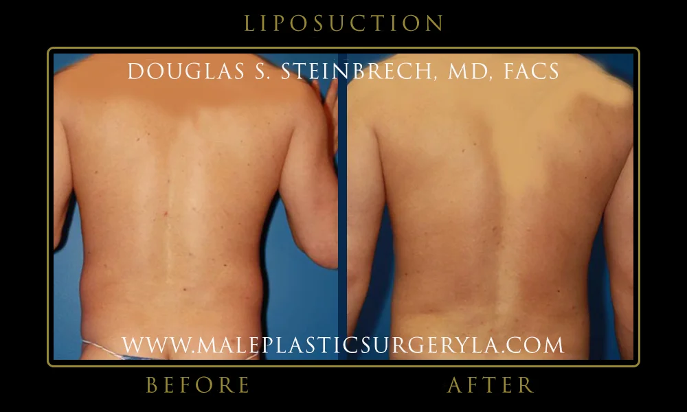 Liposuction - Before & After Photos