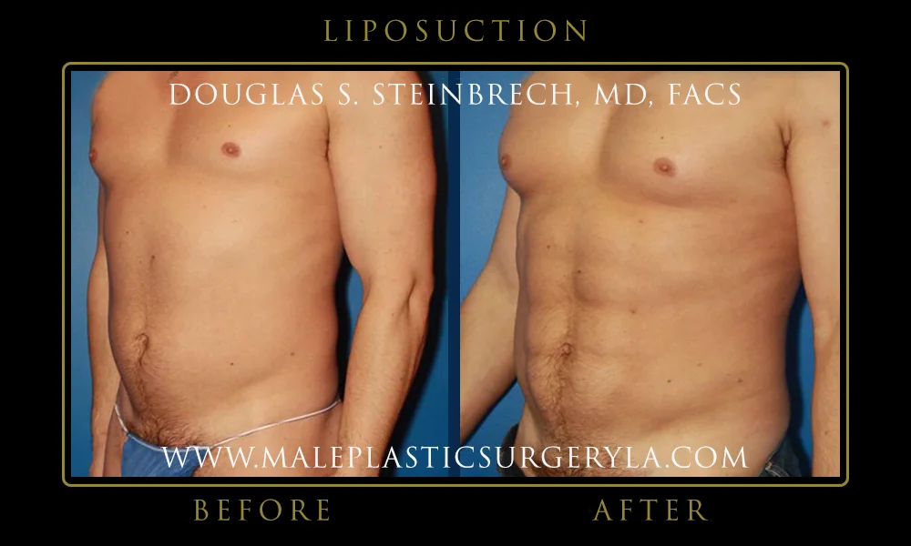 Liposuction - Before & After Photos