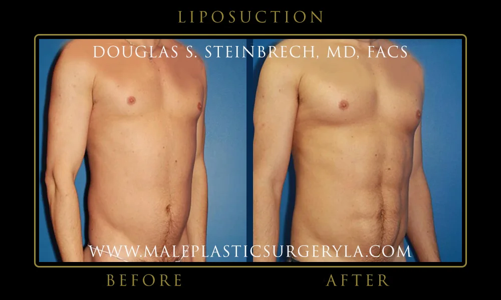 Liposuction - Before & After Photos