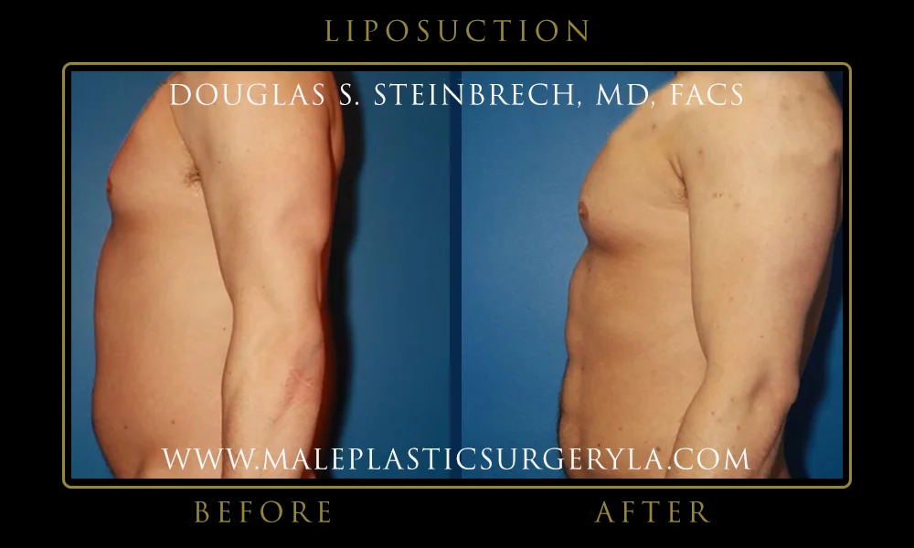 Liposuction - Before & After Photos