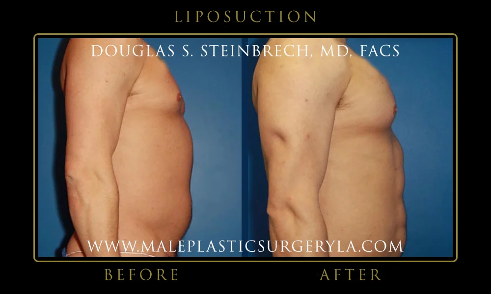 Liposuction - Before & After Photos