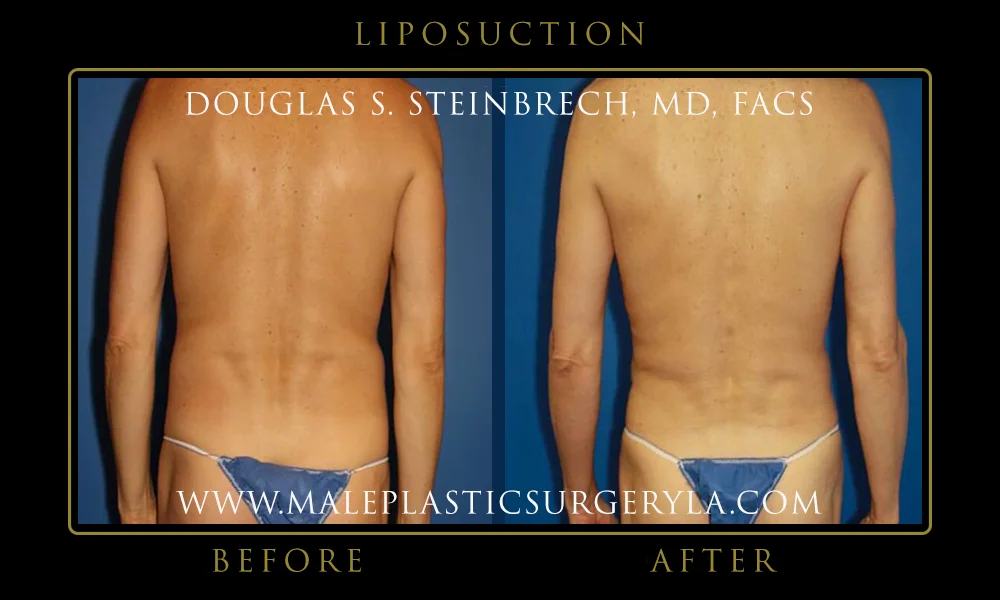 Liposuction - Before & After Photos