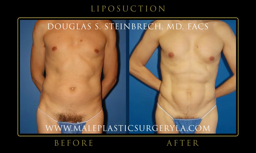 Liposuction - Before & After Photos