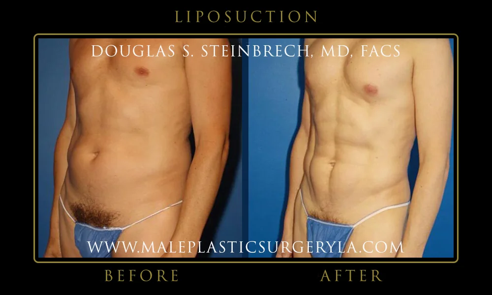 Liposuction - Before & After Photos